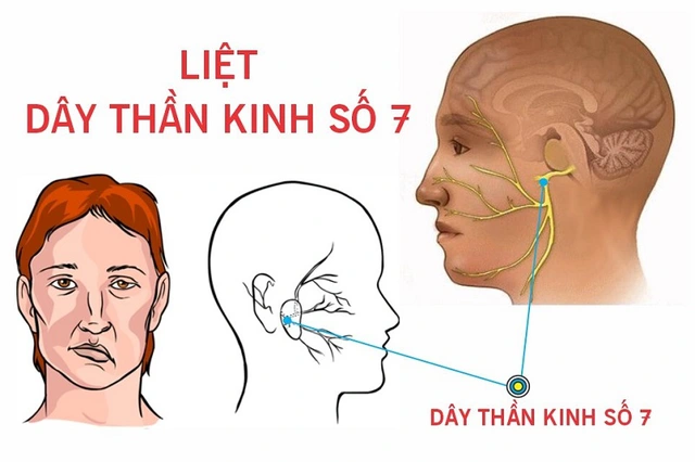 Thanh niên 23 tuổi ở Hà Nội méo miệng, liệt dây thần kinh số 7 thừa nhận mắc sai lầm này khi tắm đêm