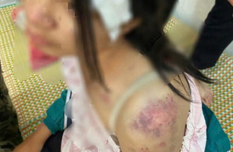 Những vết thương chi chít trên cơ thể của cô bé bị bạo hành